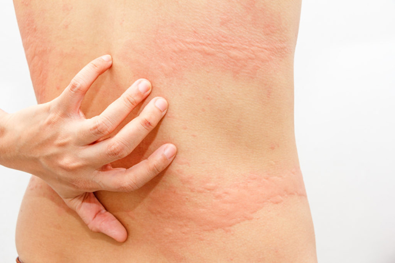 Viêm da cơ địa, mẩn ngứa bùng phát do tuyến mồ hôi hoạt động quá tải