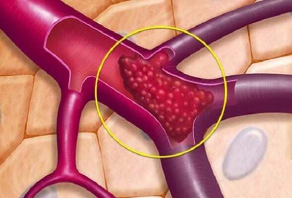 Nắng nóng đỉnh điểm: Dấu hiệu nhận biết sớm cục máu đông bạn tuyệt đối không được bỏ qua.