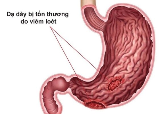 Viêm loét dạ dày tái phát do thói quen ăn đồ lạnh, uống nước đá giải khát