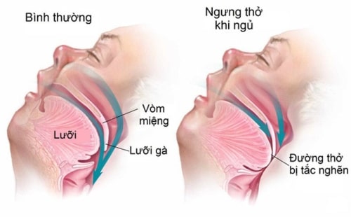Chứng ngưng thở là một loại rối loạn giấc ngủ