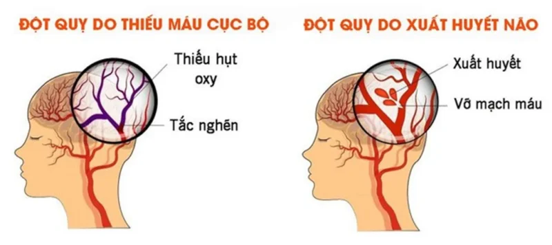 mầm mồng đột quỵ có trong cơ thể mà tỷ lệ tử vong ở Việt Nam khá cao
