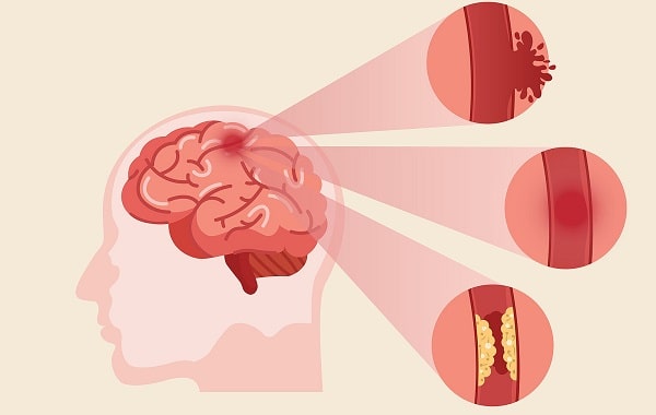 Tai biến mạch máu não xảy ra khi lưu lượng máu đến não bị gián đoạn