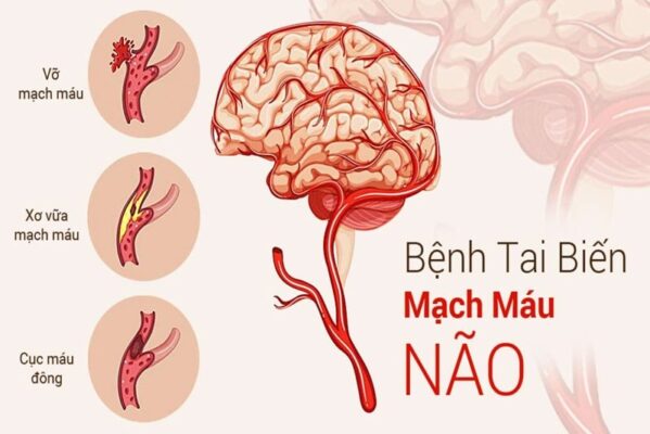 hãy để ý dấu hiệu nguy cơ tai biến