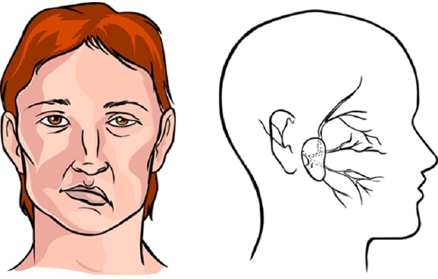 dấu hiệu đột quỵ