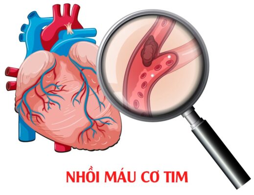 huyết áp cao - high blood pressure
