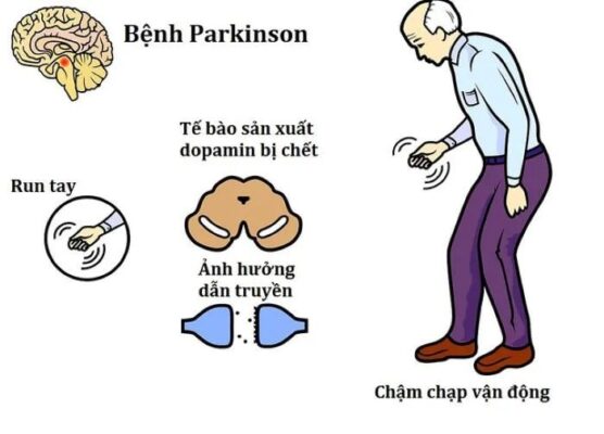 bệnh parkinson