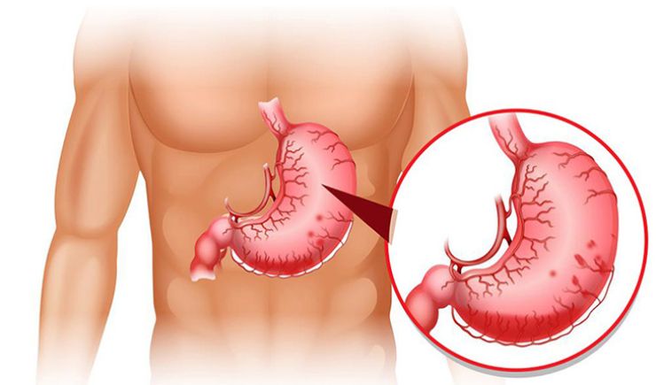viêm loét dạ dày tá tràng