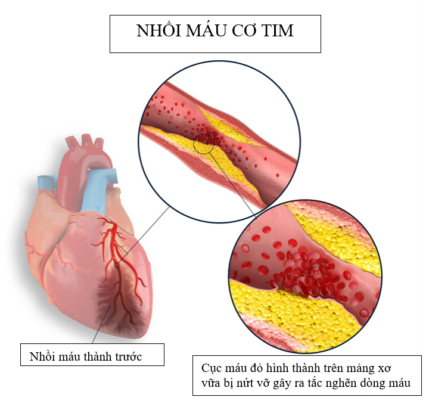 phòng ngừa nhồi máu cơ tim