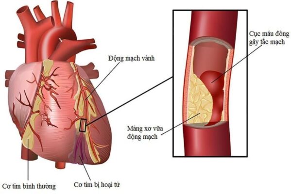 tắc nghẽn động mạch vành