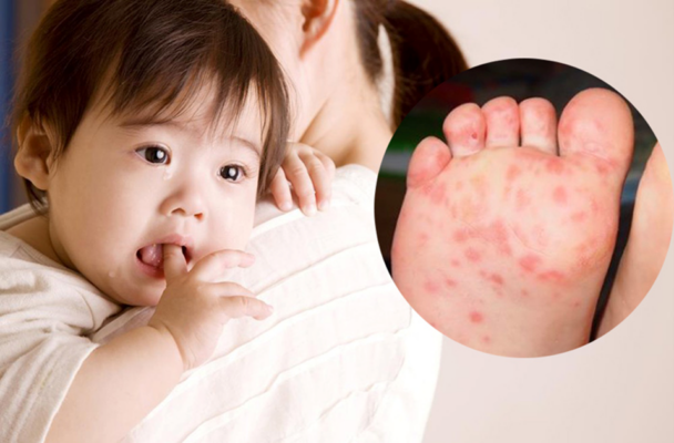bệnh tay chân miệng ở trẻ em