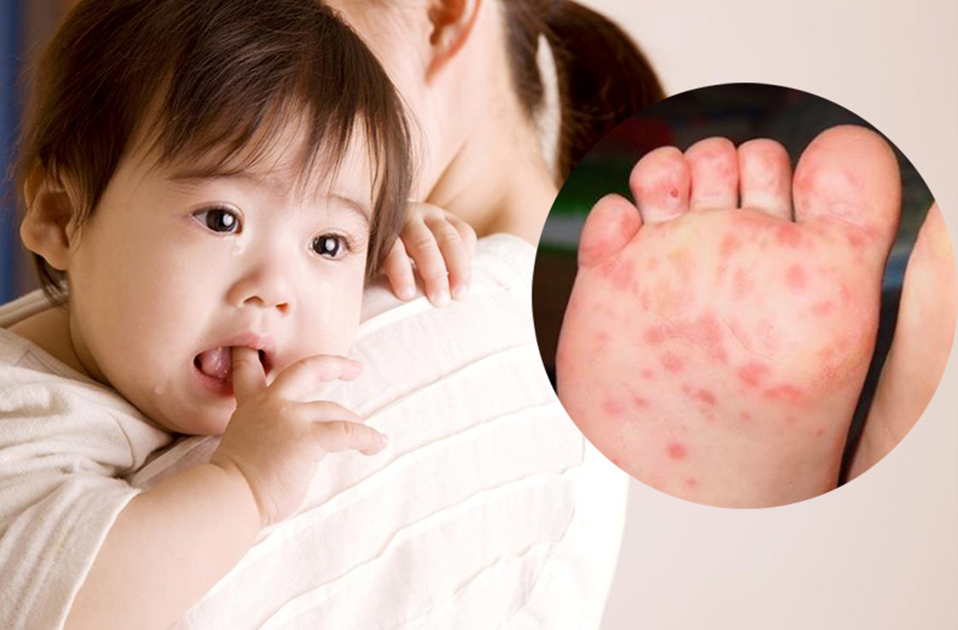 bệnh tay chân miệng ở trẻ em