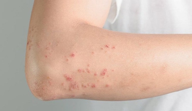 triệu chứng dị ứng thời tiết
