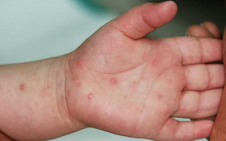 Nhận diện các nốt ban đỏ bất thường trên da trẻ vào mùa hè: Khi nào cần gặp bác sĩ?