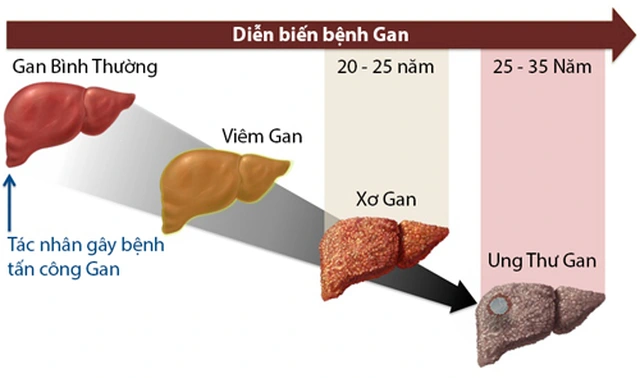 dấu hiệu cảnh báo gan bị tổn thương